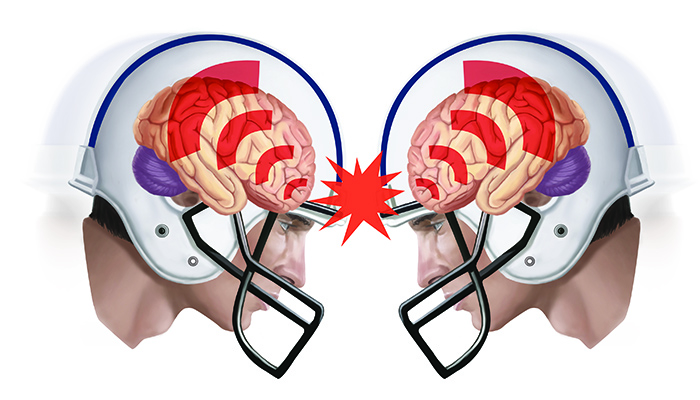 Do helmets protect against concussion?