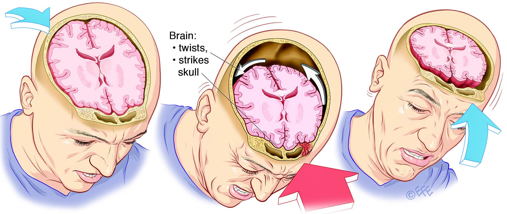 signs of serious head trauma