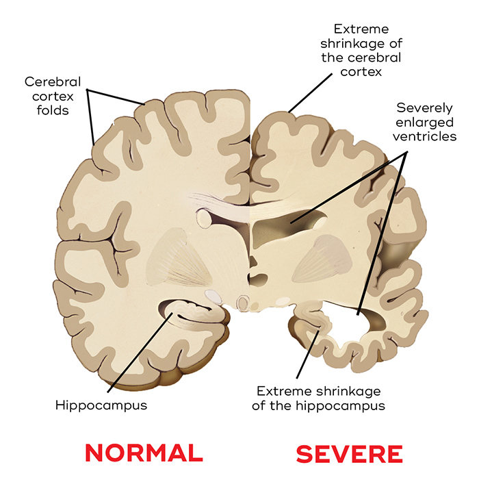 Comparison of a normal brain and degeneration from severe Alzheimer's disease