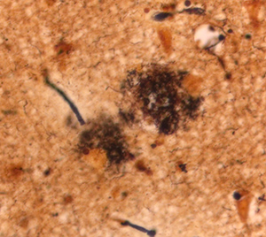 An amyloid-beta plaque in alzheimer's disease