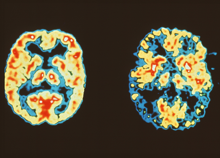 Alzheimer's disease diagnosis with PET brain scans