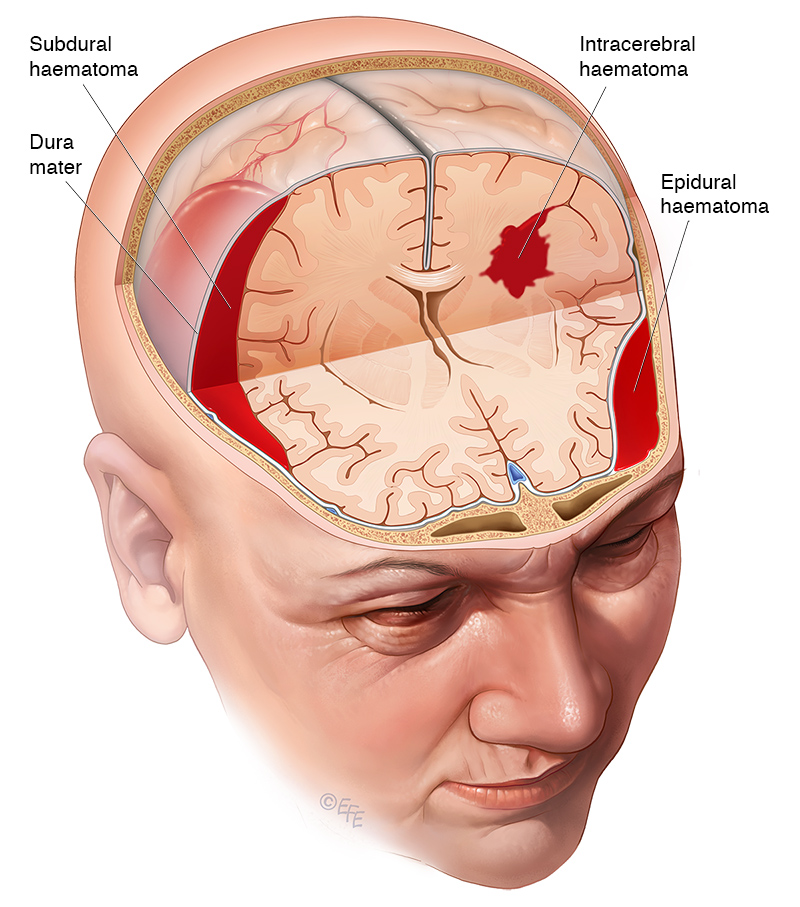 types of haematomas