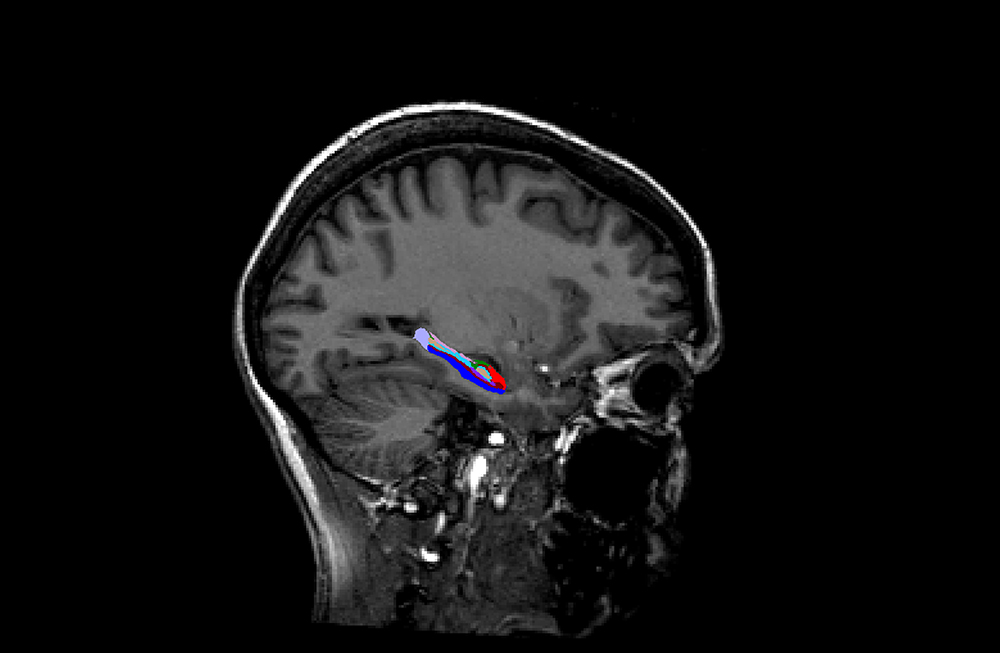 Sex Differences Found In Memory Region Of The Brain Queensland Brain Institute University Of 8652