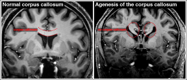 Complete Agenesis Of Corpus Callosum