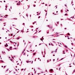A key protein involved with brain development is also associated with brain cancer, scientists have discovered.