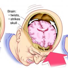 What is concussion