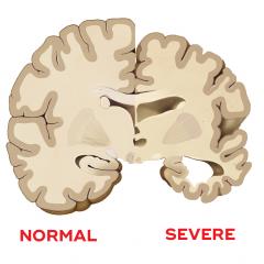 What causes dementia?