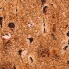 Enzyme plays key role in build-up of toxic Alzheimer's proteins
