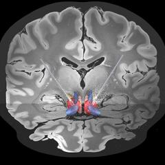 Deep brain stimulation has been found to help people with severe obsessive compulsive disorder (OCD) that has not responded to other treatment.