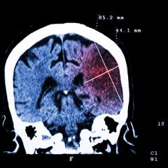 What does concussion do to the brain?